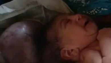 Photo of मां ने दिया दो सिरों वाले एक बच्चे को जन्म, Hospital में देखने वालों की लंबी लाइन