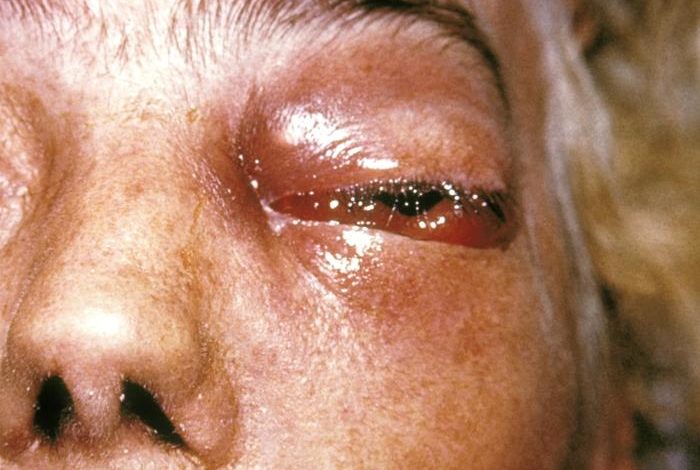 mucormycosis